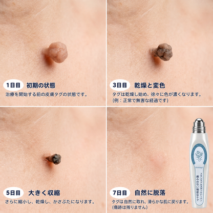 30% OFF|𝐕𝐢𝐭𝐚𝐥𝐢𝐬𝐲𝐬® 7日間 タグ＆スポットイレーサー（無痛・跡残りゼロのローラーボール）